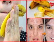 Casca de Banana Para Acne 2