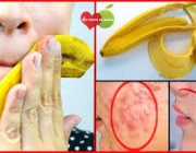 Casca de Banana Para Acne 4