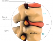 Hérnias de Disco 2