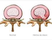 Hérnias de Disco 3