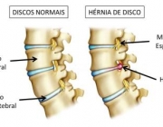 Hérnias de Disco 4