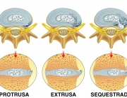 Hérnias de Disco 5