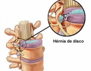 Hérnias de Disco 6