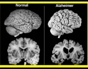Mal de Alzheimer 3