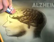 Mal de Alzheimer 5