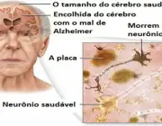 Mal de Alzheimer 1