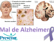 Mal de Alzheimer 2