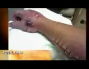 Paciente Envenenado do Picada de Cobra Coral 6