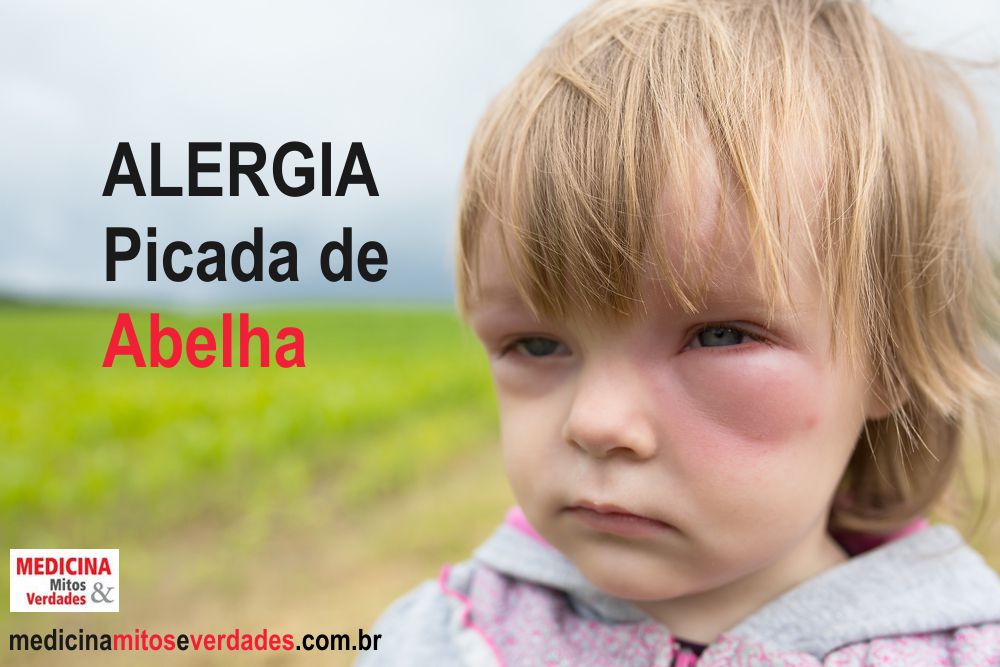 Criança Alérgica a Picada de Abelha 