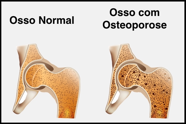 Exemplo de Osteoporose