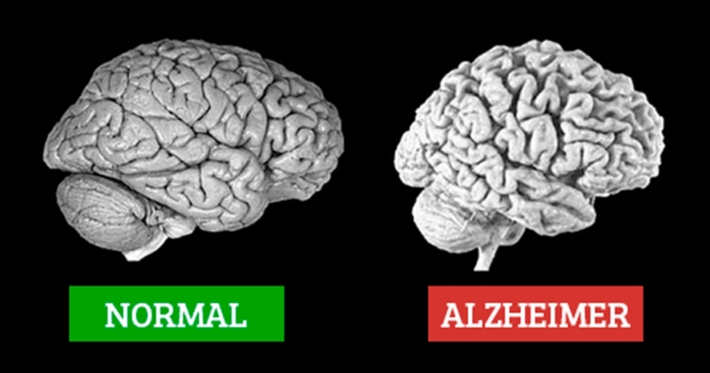 Doença de Alzheimer