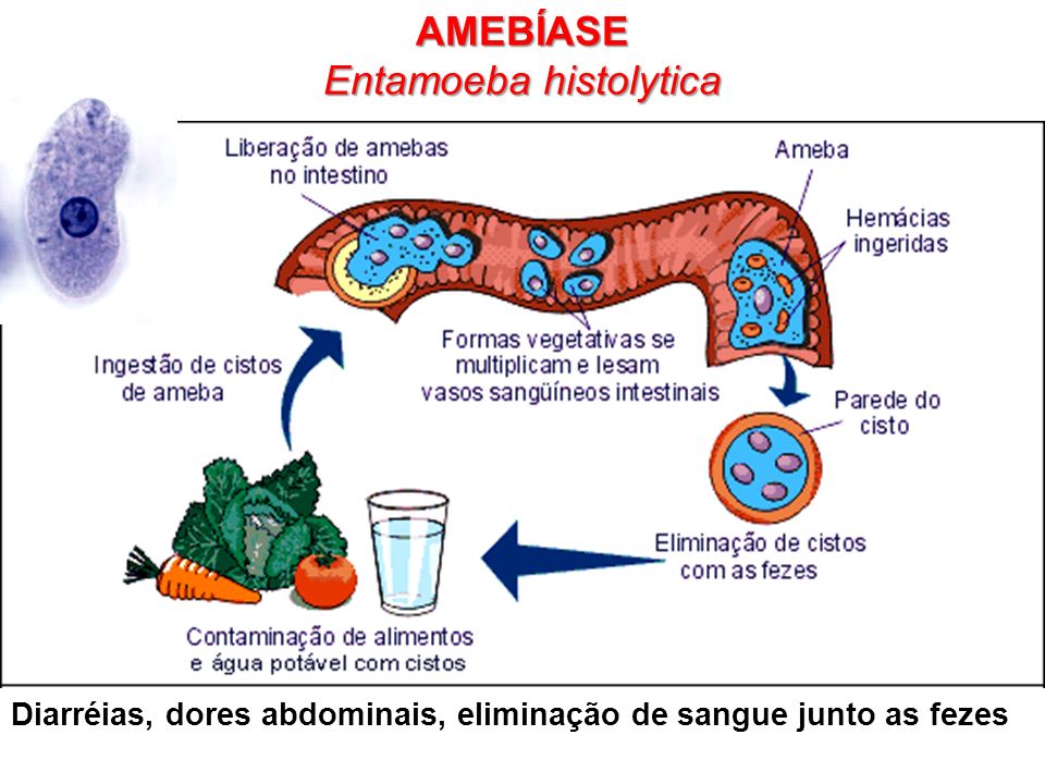 Amebíase