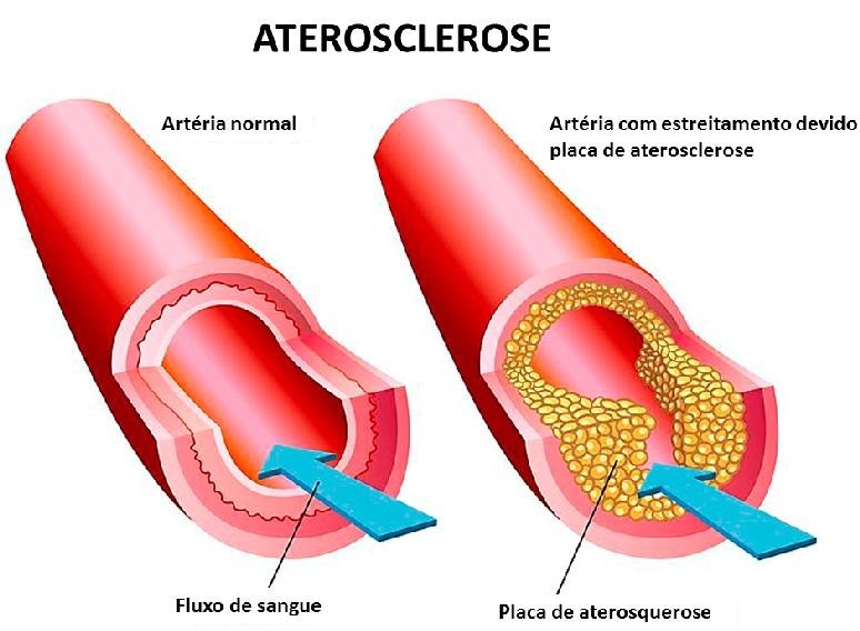 Aterosclerose