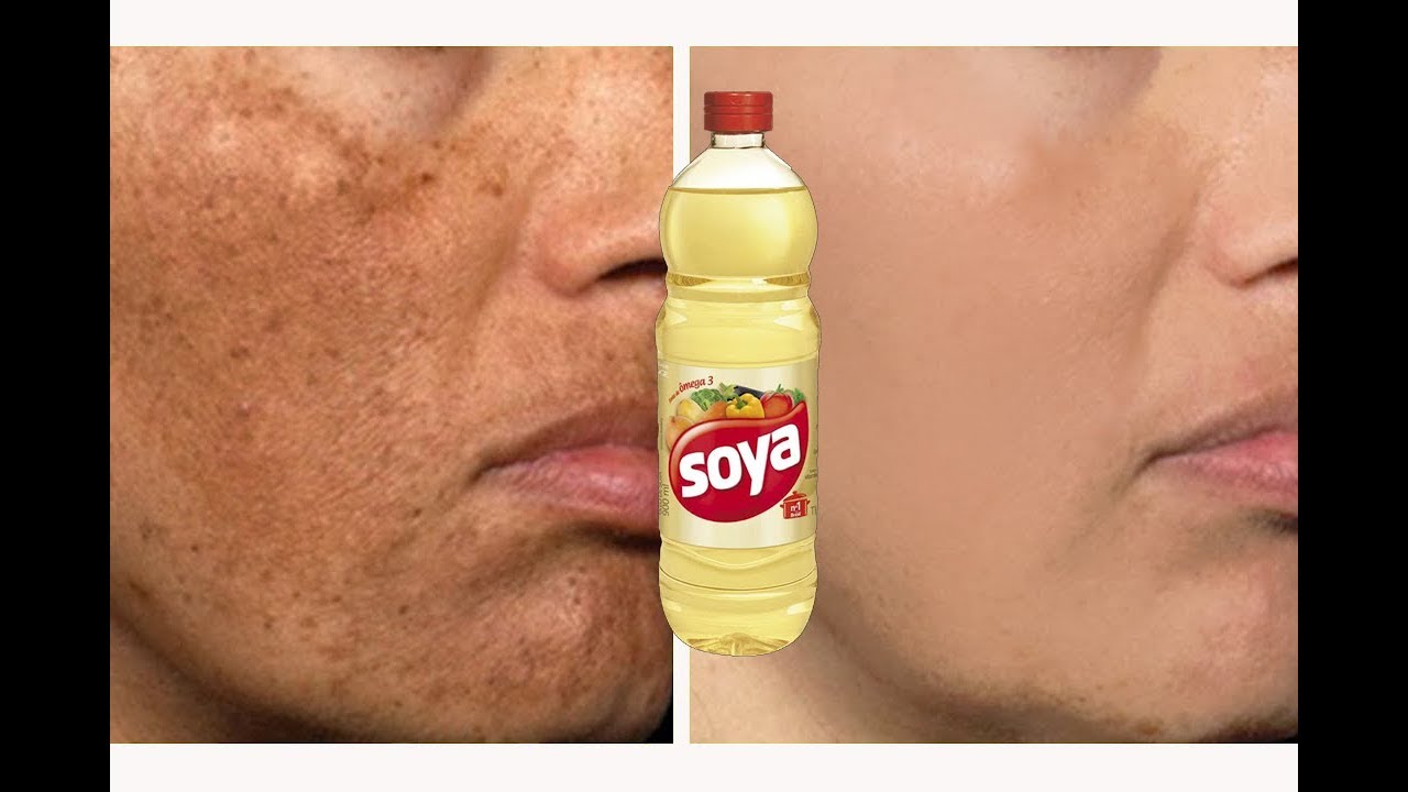 Como Usar o Óleo de Soja Para Manchas no Rosto? Faz Mal?