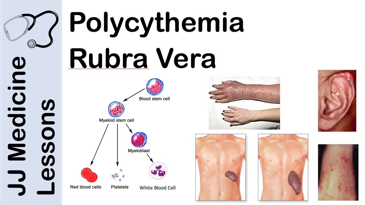 Polycythemia Rubra Vera