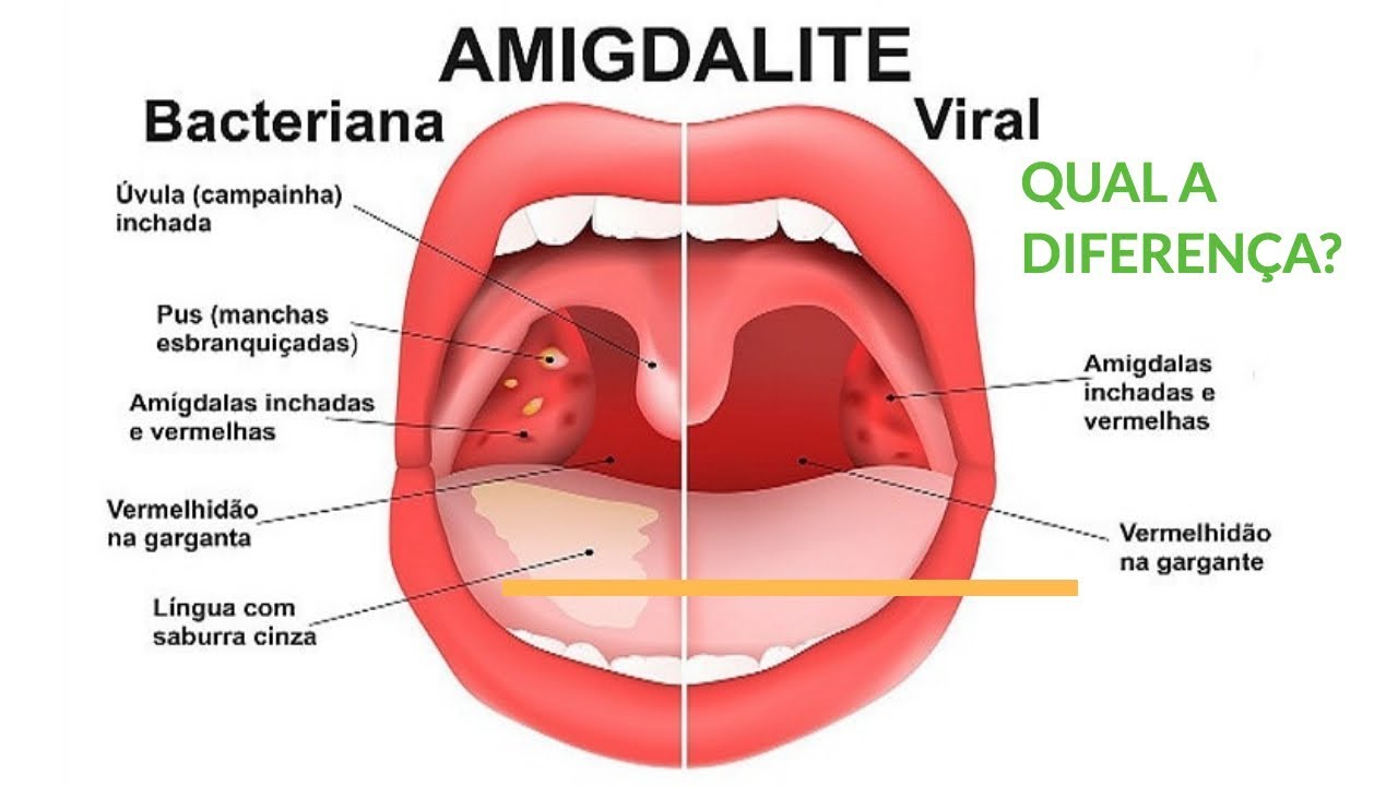 Amigdalite