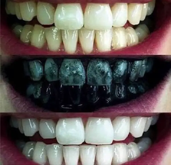 Carvão Vegetal nos Dentes - Antes, Durante e Depois 