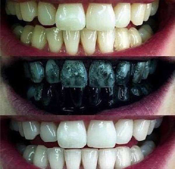Carvão Vegetal nos Dentes - Antes, Durante e Depois