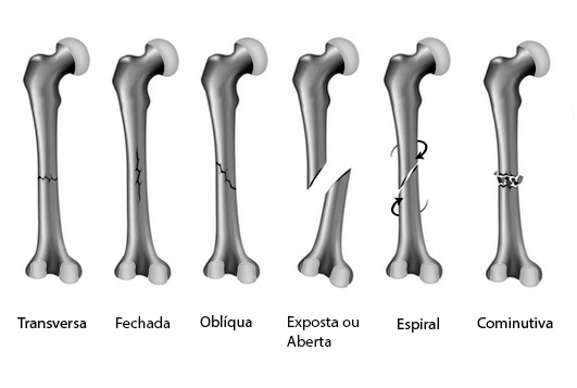 Tipos De Fraturas