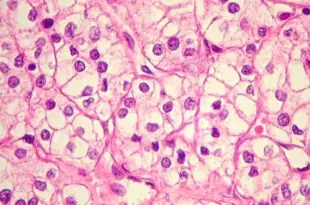 Carcinoma de Células Claras