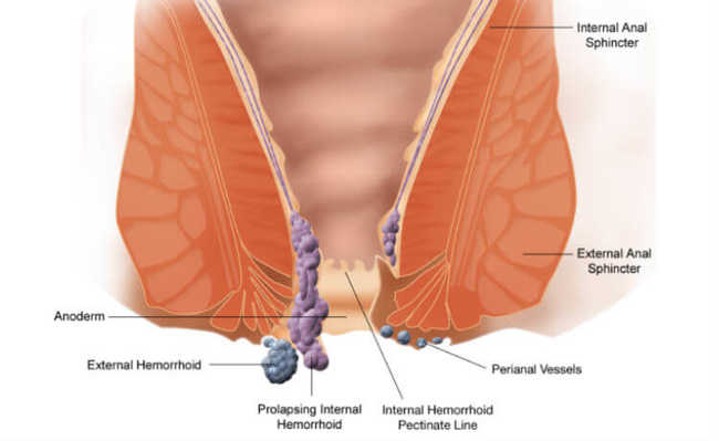 Hemorroidas