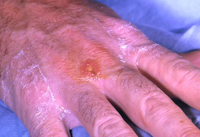 Tularemia na Mão 