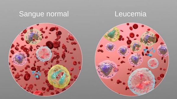 Leucemia